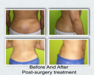 Masajes Drenaje Linfatico 7 Post cirugia Estetica