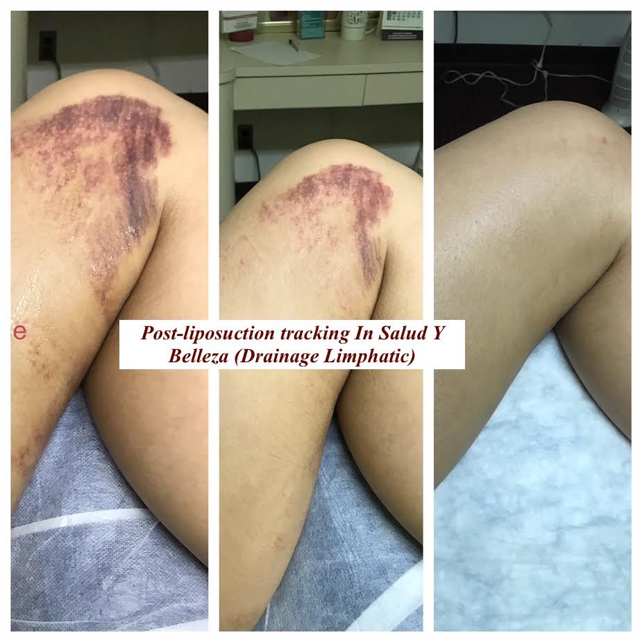 Masajes Drenaje Linfatico 2 Masajes drenaje linfatico con ultrasonido