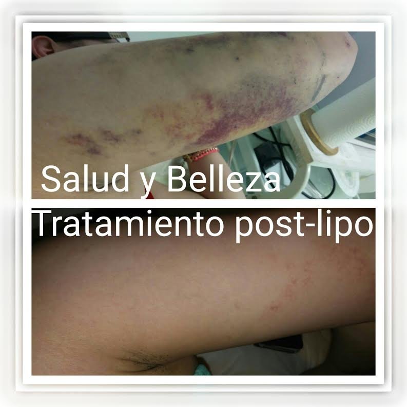 Masajes Drenaje Linfatico 6 Drenaje post Op