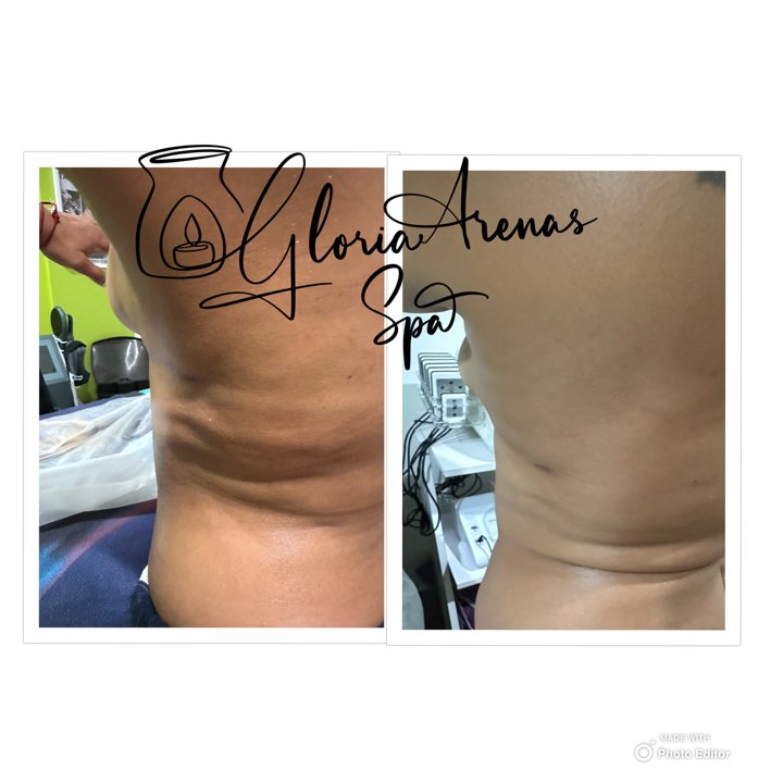 Masajes Drenaje Linfatico 9 post op