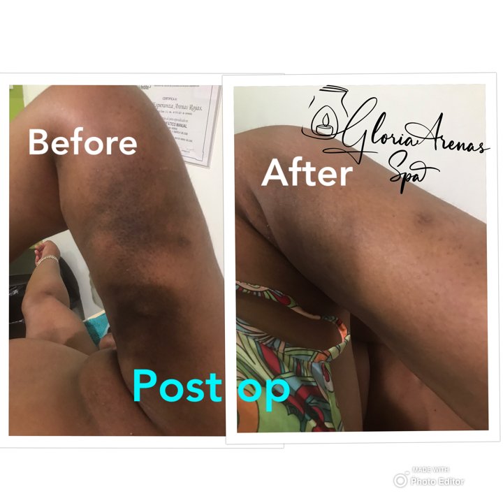 Masajes Drenaje Linfatico 10 Antes Despes cirugia estetica