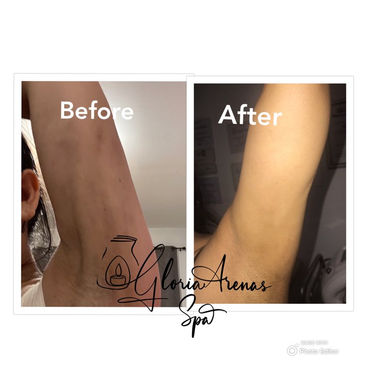 Masajes Drenaje Linfatico 11 Masajes Drenaje linfatico post cirugia